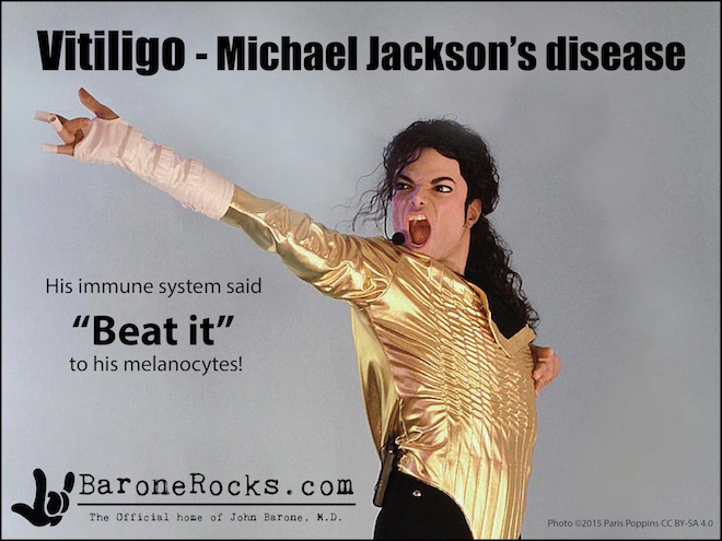 Vitiligo4