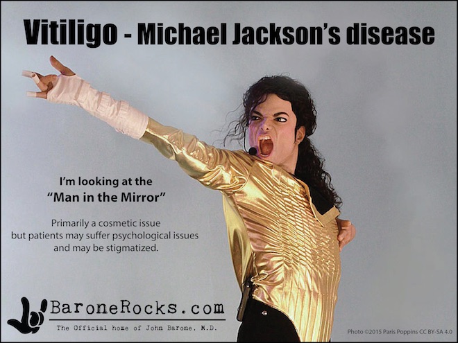 Vitiligo9